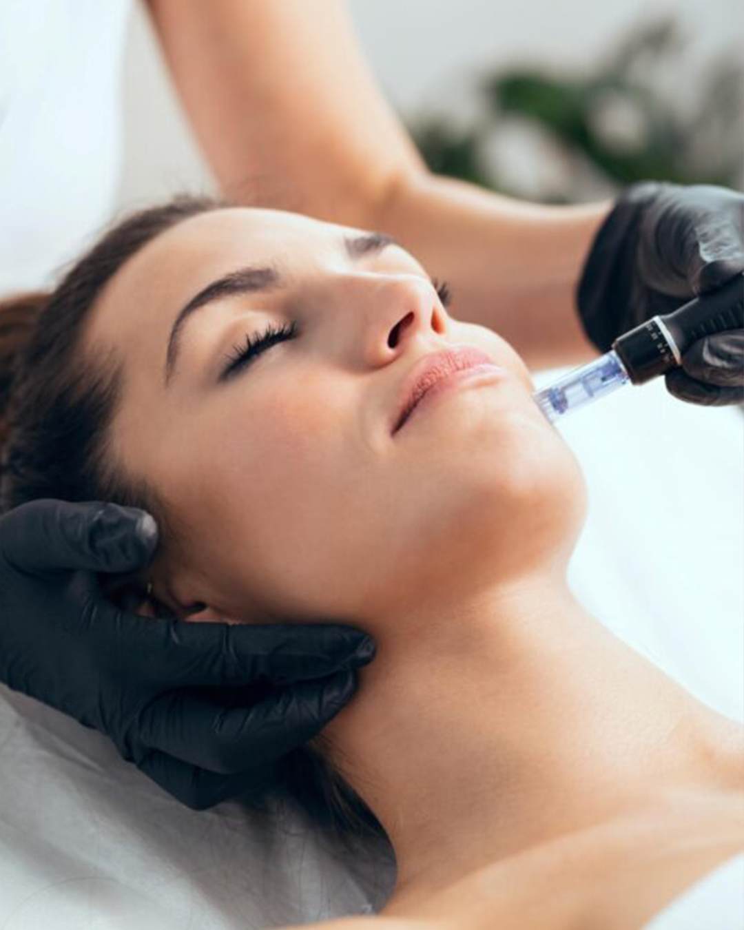 Micro Needling (002)(1)