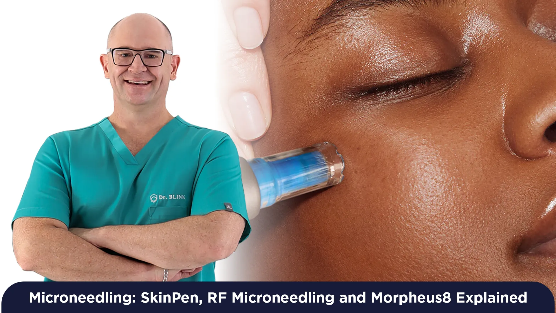 Microneedling in Cape Town: SkinPen, RF Microneedling and Morpheus8 Explained