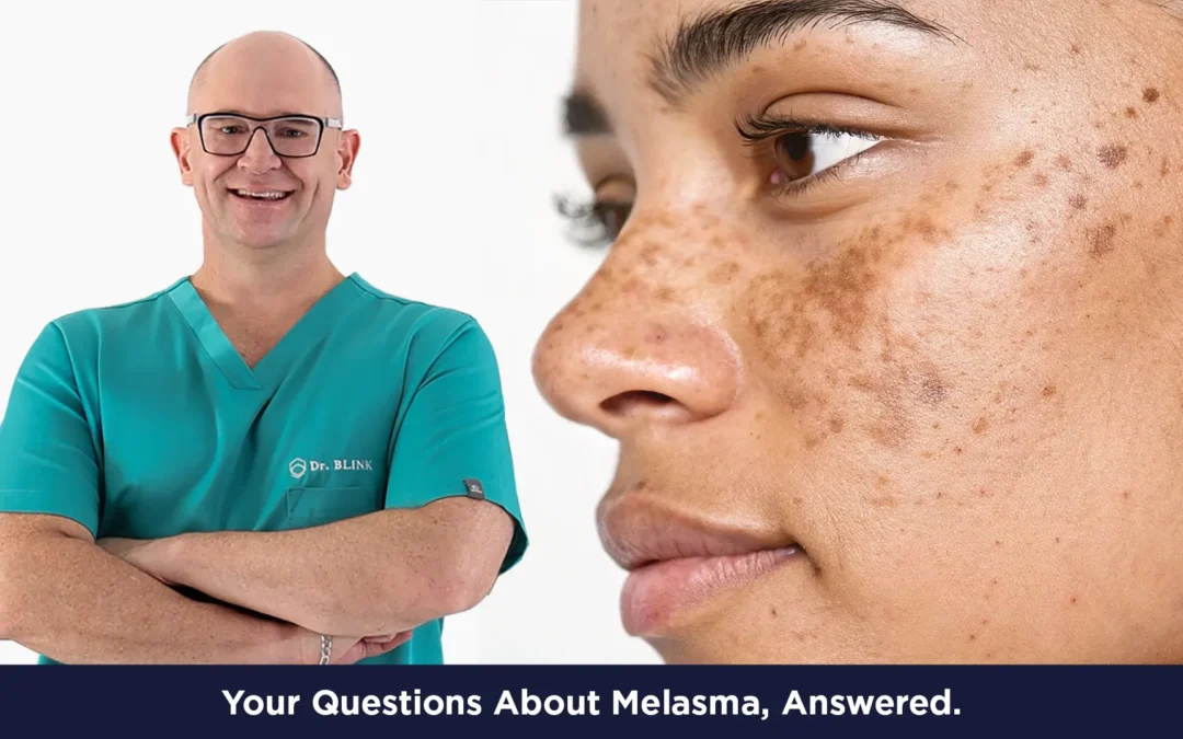 Your Questions About Melasma, Answered